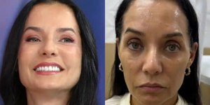 Atriz Mônica Carvalho faz harmonização facial e surpreende