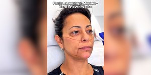 Antes e depois de Samantha após consulta com médico da Kardashian