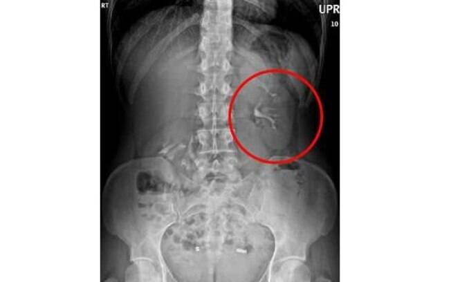 A chamada síndrome do rim flutuante, capaz de fazer o órgão se mover em até cinco centímetros, é muito rara