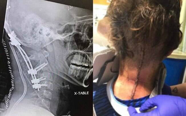 Após a cirurgia para reparar os danos da decapitação interna, o paciente passou por um intenso processo de recuperação Após a cirurgia para reparar os danos da decapitação interna, o paciente passou por um intenso processo de recuperação