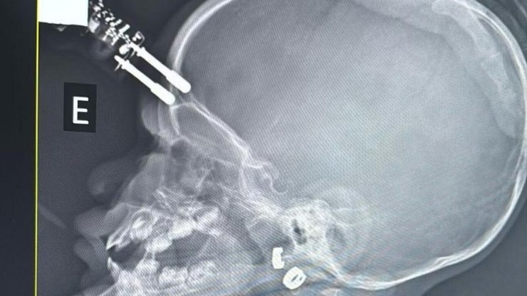 Beb%C3%AA%20cai%20da%20cama%20e%20fica%20com%20carregador%20cravado%20na%20testa