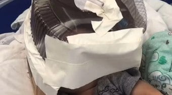 Bebê que usou máscara de oxigênio improvisada deixa UTI