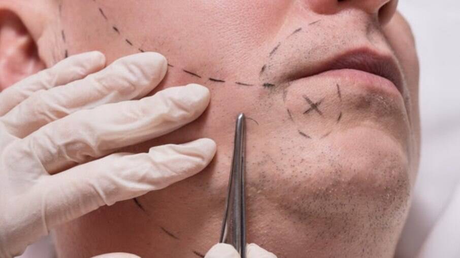 Transplante de barba é realizado com tecnologia semelhante ao transplante capilar