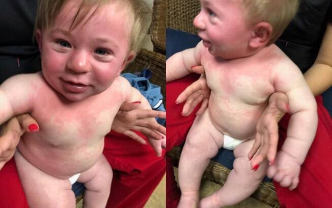 O pequeno Lofton Hyde ficou com o corpo cheio de manchas e dificuldade para respirar após ter reação alérgica grave