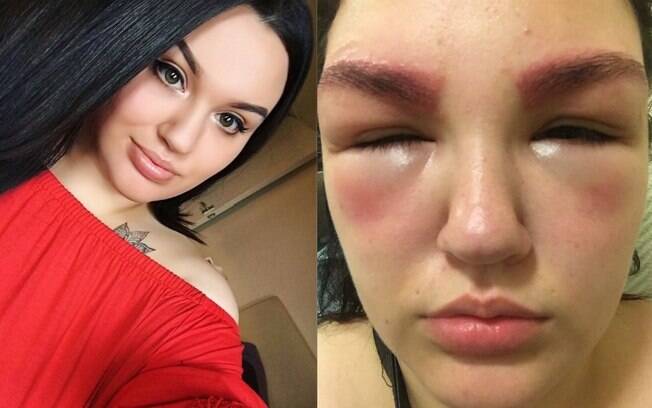 Hannah Corrigan não passou por um teste alérgico antes de realizar pigmentação e depilação de sobrancelha