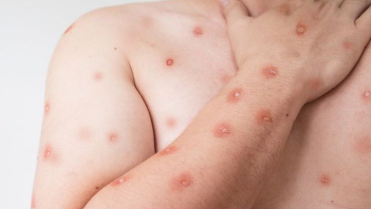 Nova%20cepa%20da%20Mpox%20tem%20segundo%20caso%20registrado%20no%20Brasil