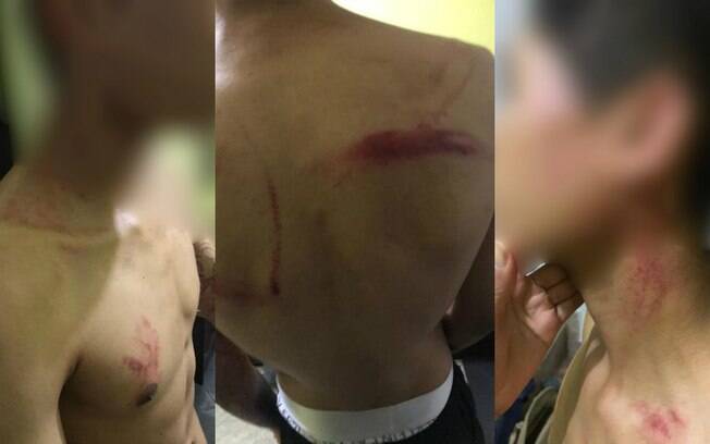 Foto que mostra os ferimentos no adolescente.