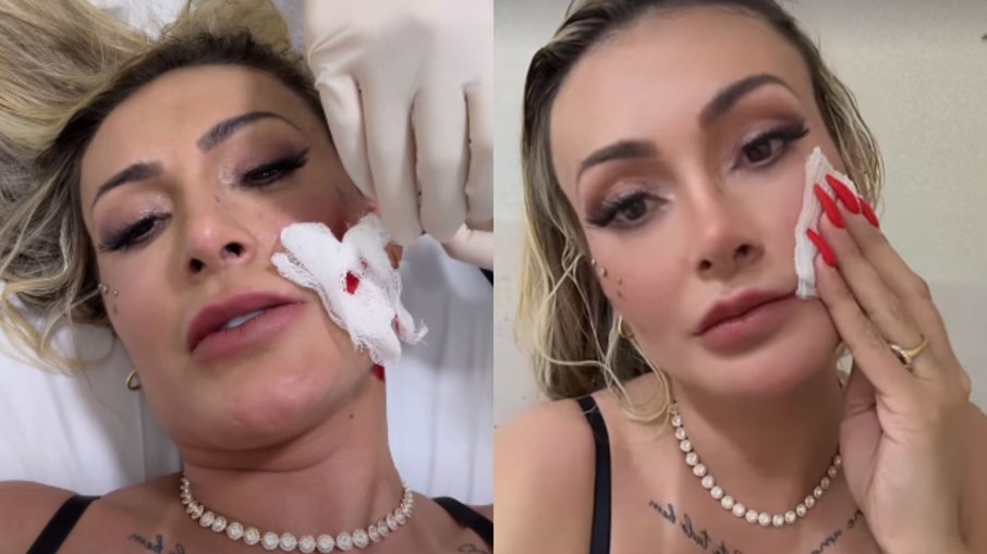 Andressa Urach com rosto machucado