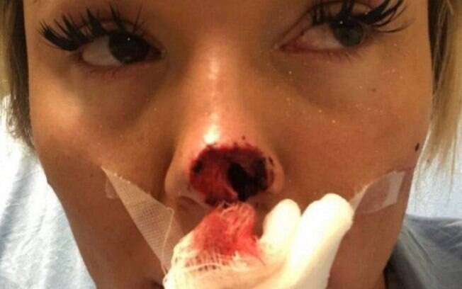 Allyson teve a ponta do nariz arrancada pelo namorado