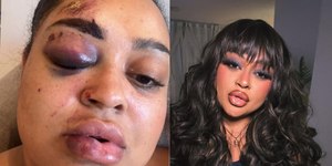 Ex-BBB Rízia Cerqueira revela acidente de moto e exibe hematomas