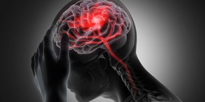 Casos de AVC em jovens aumentam quase 60% no Brasil