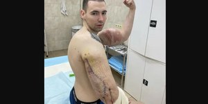 "Popeye" russo pode perder os dois braços por uso de esteróides