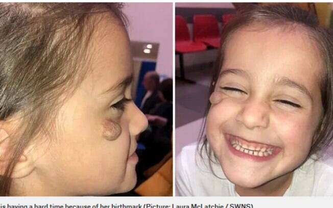 Laila McLatchie tem um hemangioma ulcerado no rosto, condição que a faz sofrer constantemente com o bullying