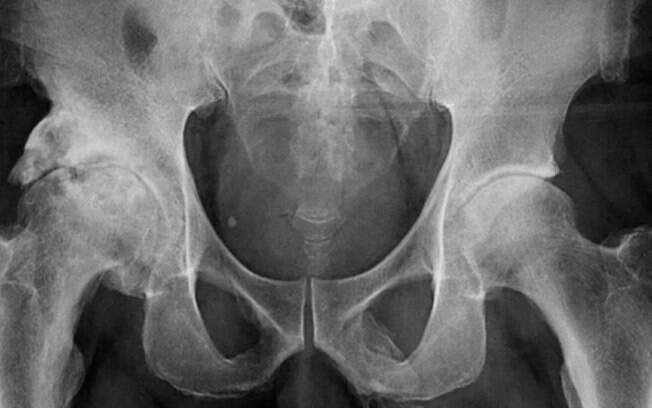 Exame de raio-x identificou que pênis de idoso está se calcificando