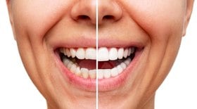 Lentes de contato dentais não são para todos