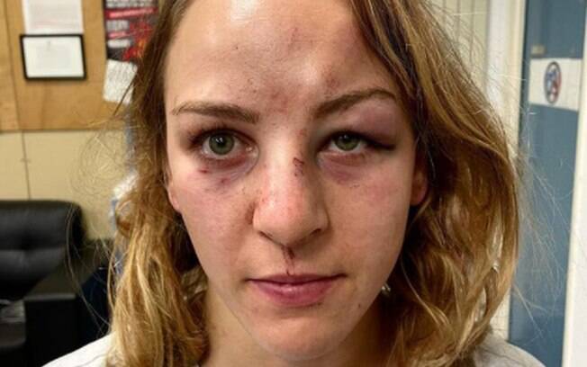 Campeã olímpica posta foto do rosto machucado e acusa marido de agressão