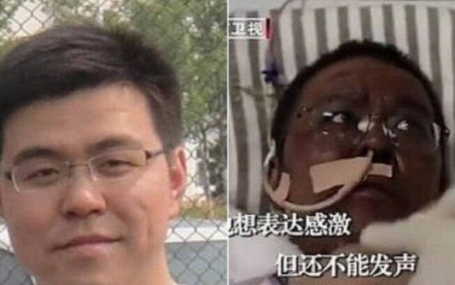Hu Weifeng antes e depois do tratamento para Covid-19 que causou alterações na pele por afetar o fígado