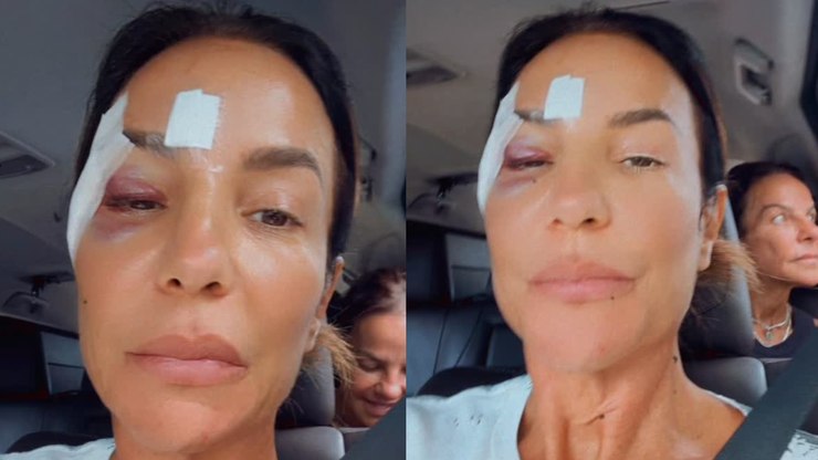 Ivete Sangalo recebe alta e deixa hospital com olho roxo