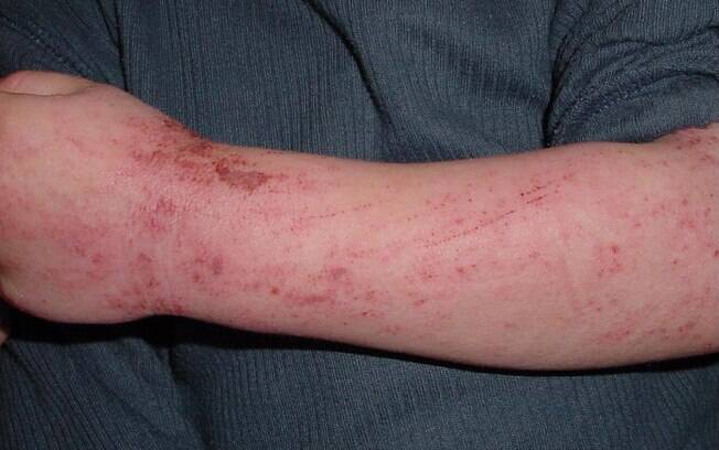 Dermatite atópica atinge cerca de 20% das crianças e 3% delas continua com a doença na fase adulta