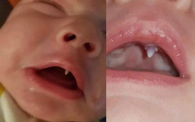 Bebê com dente chamou a atenção da mãe e de médicos. Ele tinha apenas 11 semanas quando o dente apareceu