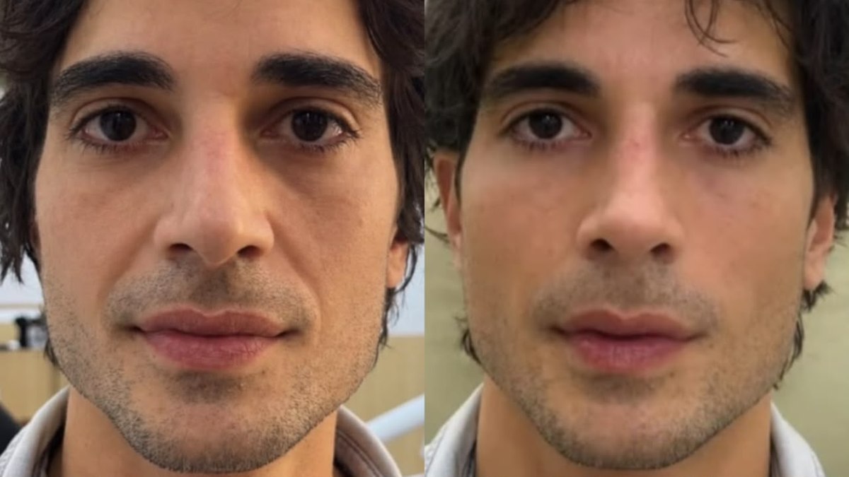Fiuk faz harmonização facial no SBT e surpreende com resultado Fiuk faz harmonização facial no SBT e surpreende com resultado