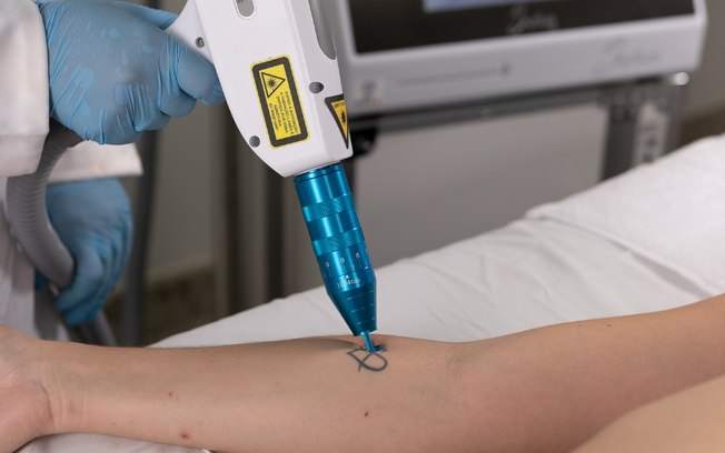 Procura por remoção de tatuagens cresce no Brasil