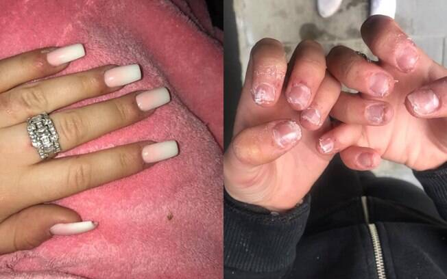 Paige compartilhou fotos do resultado depois do procedimento para colocação de unhas de acrílico que deu errado