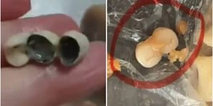 Clientes acham dentes humanos em alimentos 3 vezes em uma semana