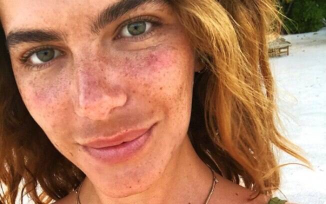 Mariana Goldfarb fala sobre melasma em rede social Mariana Goldfarb fala sobre melasma em rede social