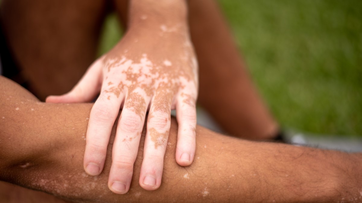 Manchas brancas na pele podem ser sinal de vitiligo Manchas brancas na pele podem ser sinal de vitiligo
