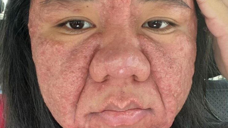 Acne%20grav%C3%ADdica%3A%20como%20a%20gravidez%20afeta%20a%20pele%20da%20gestante