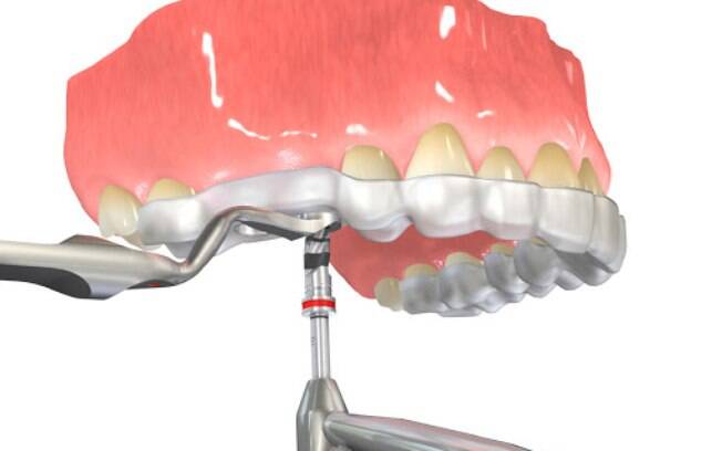 Cirurgia guiada para implantes dentários