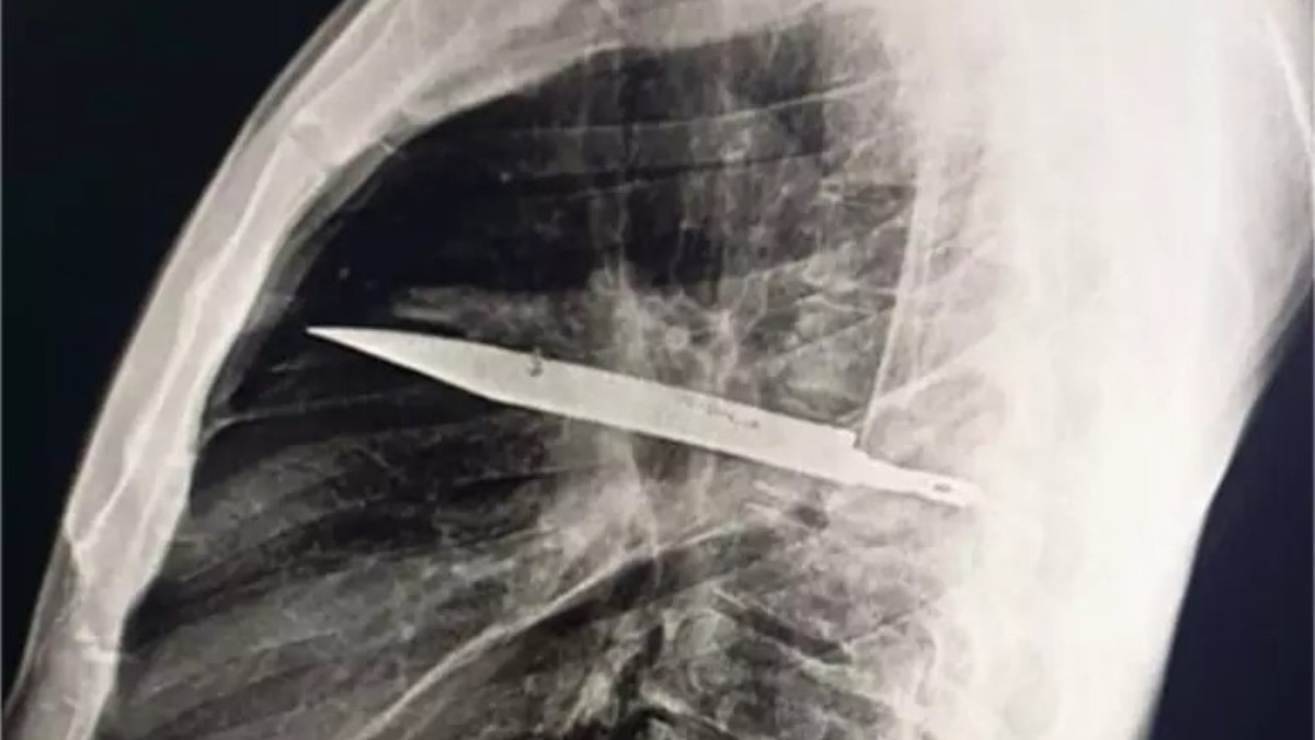 Radiografia mostra lâmina alojada no peito