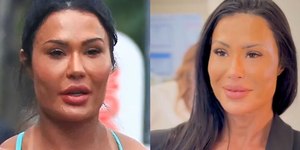 Gracyanne Barbosa remove preenchimento do rosto; veja antes e depois