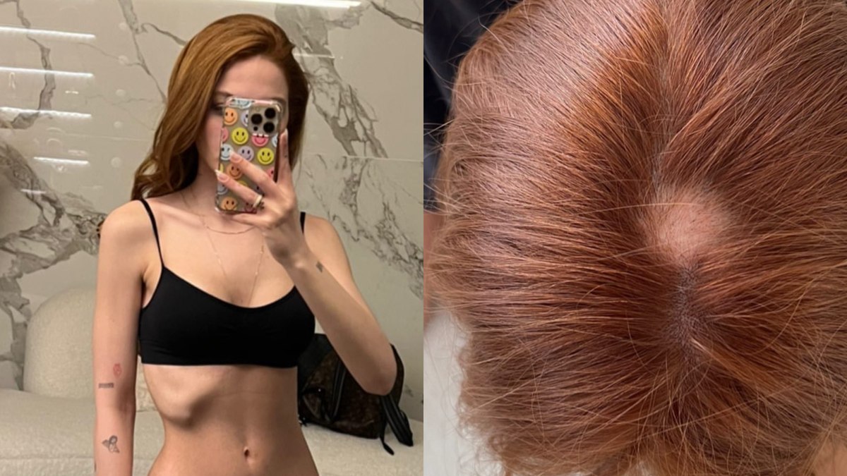 Sarah Poncio revela que teve depressão e alopecia