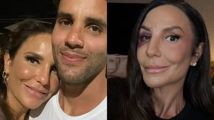 Ex-marido de Ivete Sangalo fala sobre cirurgia da cantora: "Aço"