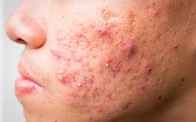 Acne severa acontece quando as pústulas se tornam cistos e abscessos, de acordo com a SBD Acne severa acontece quando as pústulas se tornam cistos e abscessos, de acordo com a SBD