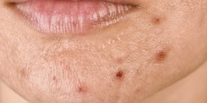 Tem espinhas depois dos 25? Você pode ter acne adulta