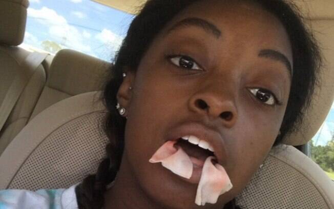 Simone Biles com a boca inchada e cheia de gaze após retirar os dentes sisos