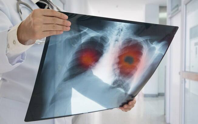 O ‘teste da janela de Schamroth’ pode ajudar a identificar se o paciente está com câncer de pulmão; saiba como fazer