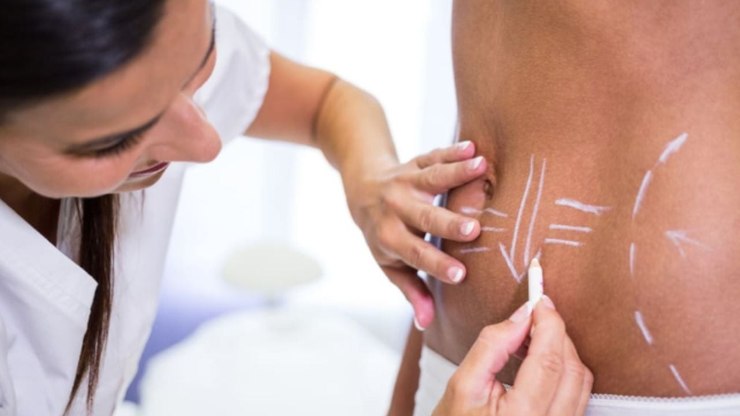 Hidrolipo: saiba o que é esse procedimento e se ele possui riscos