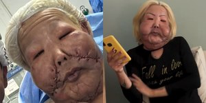 Médico detalha cirurgia de Juju do Pix; veja antes e depois