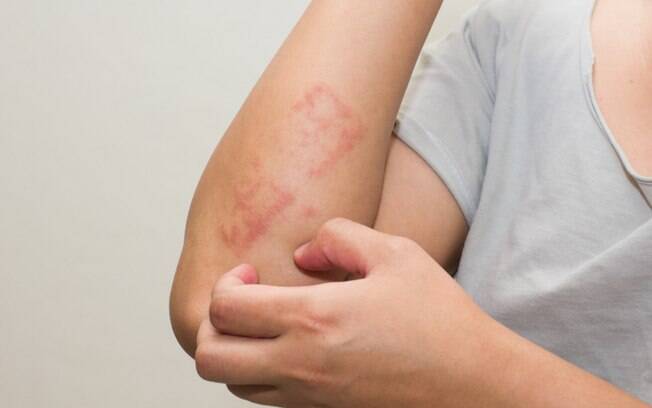 Doenças de pele: estresse e ansiedade podem causar irritações no corpo