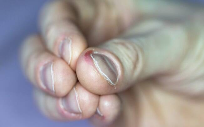 Roer as unhas pode causar infecções graves no corpo Roer as unhas pode causar infecções graves no corpo
