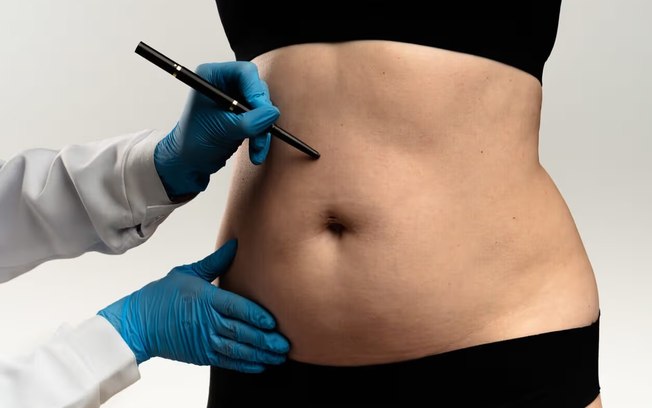 Lipoaspiração lidera preferência por cirurgias plásticas Lipoaspiração lidera preferência por cirurgias plásticas