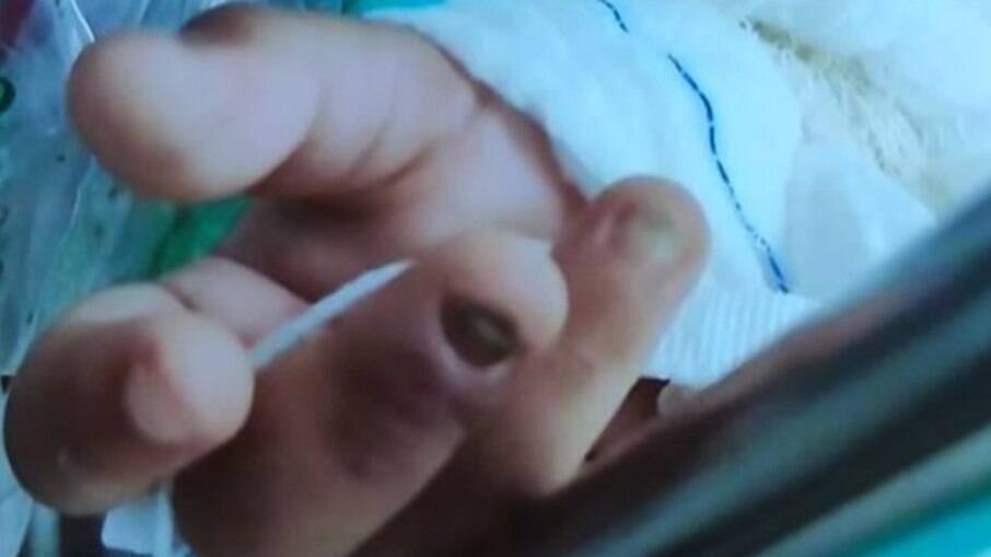 Criança chegou ao hospital sem duas unhas e com ferimentos pelo corpo