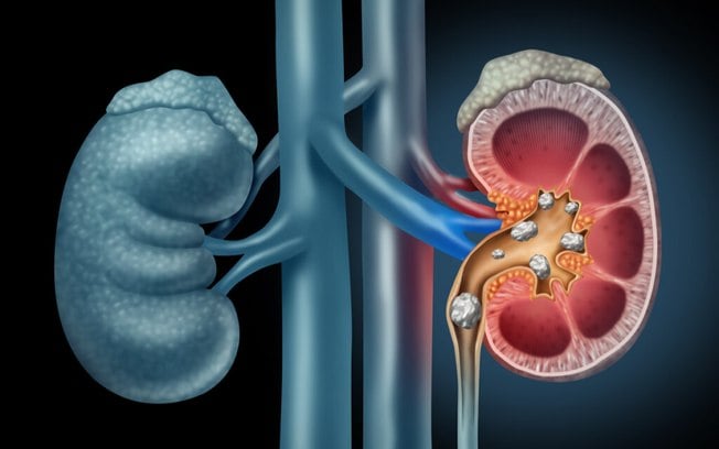 Pedras nos rins: conheça as causas, os sintomas e as formas tratamento