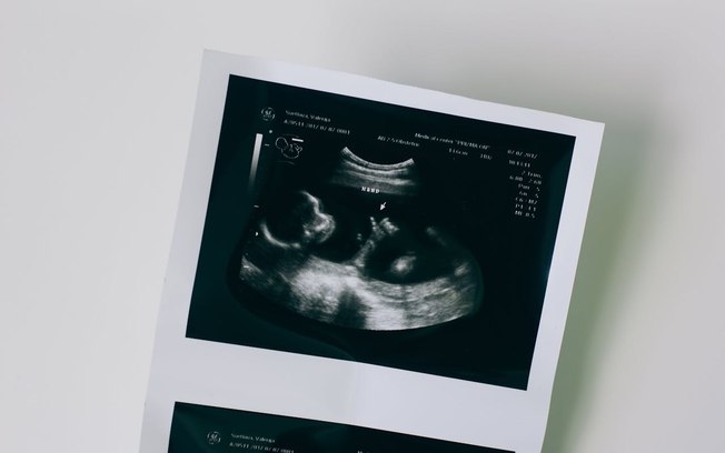 Cirurgia fetal minimamente invasiva tem resultado promissor