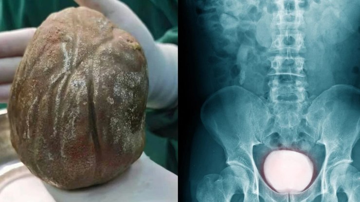 Pedra gigante de 1,3kg é retirada da bexiga de homem
