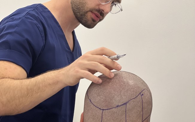 FUE é o transplante capilar mais realizado entre os homens